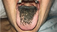 Hốt hoảng vì lưỡi chuyển màu đen sì và mọc lông do dùng kháng sinh
