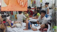 Tất cả các quận, huyện ở Hà Nội đều đã có bệnh nhân mắc sởi, sốt xuất huyết