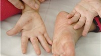 43.700 ca mắc bệnh tay chân miệng trên cả nước