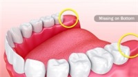Tại sao răng khôn cần phải được phẫu thuật loại bỏ?