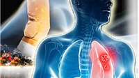 Làm gì để đối phó ung thư phổi?