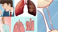 Vì sao khi phát hiện bệnh ung thư phổi thường đã ở giai đoạn muộn?