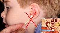 Từ vụ nhiễm trùng não do dùng tăm bông ngoáy tai, bác sĩ chỉ cách vệ sinh tai an toàn, hiệu quả