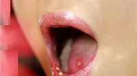 Dấu hiệu phát hiện ung thư khoang miệng sớm nhất
