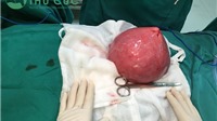 Bệnh viện Thu Cúc phẫu thuật khối u tử cung có kích thước như quả bưởi  