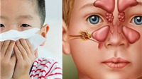 Trẻ viêm xoang suýt mù vì biến chứng