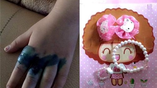 Bé gái bị phồng rộp bàn tay vì đeo nhẫn đồ chơi Trung Quốc