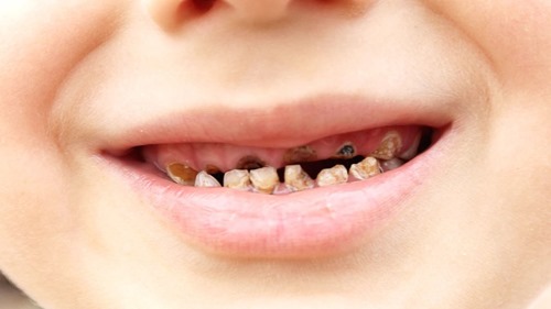 Trẻ bị sâu và sún răng, bố mẹ nên làm gì?