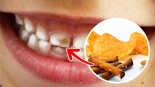 Bất ngờ các thực phẩm làm hỏng hàm răng xinh