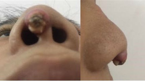 Nhiễm trùng, biến dạng mũi vì làm đẹp tại spa tại gia