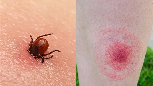 Nhận diện và cách chữa trị các vết côn trùng cắn
