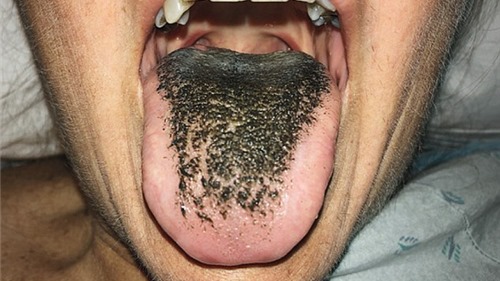 Hốt hoảng vì lưỡi chuyển màu đen sì và mọc lông do dùng kháng sinh