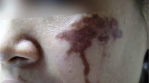 Trị nám bằng axit ở spa, một phụ nữ bị bỏng nặng
