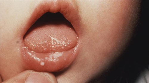 Trẻ sơ sinh vừa chào đời đã có răng: Vì sao cha mẹ cố gìn giữ nhưng bác sĩ chỉ muốn nhổ bỏ?
