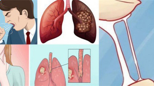 Vì sao khi phát hiện bệnh ung thư phổi thường đã ở giai đoạn muộn?