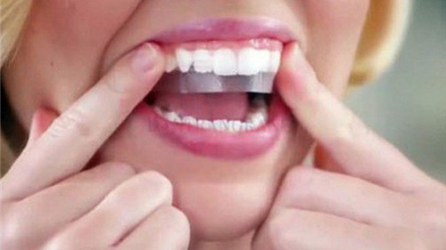 Cẩn trọng làm đẹp “cấp tốc” đón Tết bằng miếng dán làm trắng răng