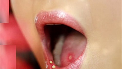 Dấu hiệu phát hiện ung thư khoang miệng sớm nhất