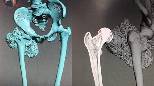 Lần đầu tiên tại Việt Nam ghép thành công xương đùi nhân tạo in 3D