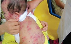 Lo dịch sởi bùng phát, Bộ Y tế xem xét đẩy tuổi tiêm vắc xin sớm hơn 3 tháng