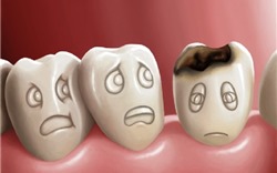 Những bệnh cực nguy hiểm về răng miệng bạn dễ mắc phải