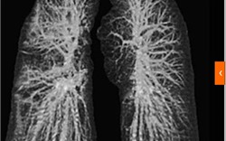 Hình ảnh gây sốc về phổi của bệnh nhân Covid-19 