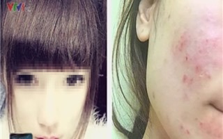 Dùng mỹ phẩm, nữ sinh Hà Nội bị nhiễm độc da và nguy cơ vô sinh