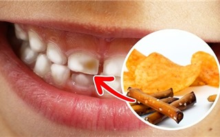 Bất ngờ các thực phẩm làm hỏng hàm răng xinh