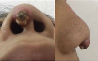 Nhiễm trùng, biến dạng mũi vì làm đẹp tại spa tại gia