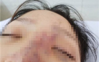 Chủ spa biến mất sau vụ tiêm filler khiến nữ sinh Sài Gòn mù mắt