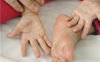 43.700 ca mắc bệnh tay chân miệng trên cả nước