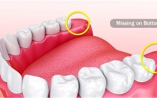 Tại sao răng khôn cần phải được phẫu thuật loại bỏ?