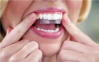 Cẩn trọng làm đẹp “cấp tốc” đón Tết bằng miếng dán làm trắng răng