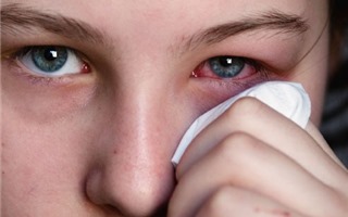 Nguyên nhân gây đau và cách bảo vệ mắt trong mùa xuân 