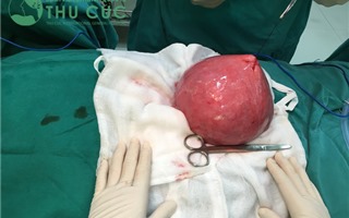 Bệnh viện Thu Cúc phẫu thuật khối u tử cung có kích thước như quả bưởi  