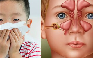 Trẻ viêm xoang suýt mù vì biến chứng