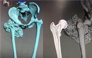 Lần đầu tiên tại Việt Nam ghép thành công xương đùi nhân tạo in 3D