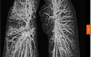 Hình ảnh gây sốc về phổi của bệnh nhân Covid-19 